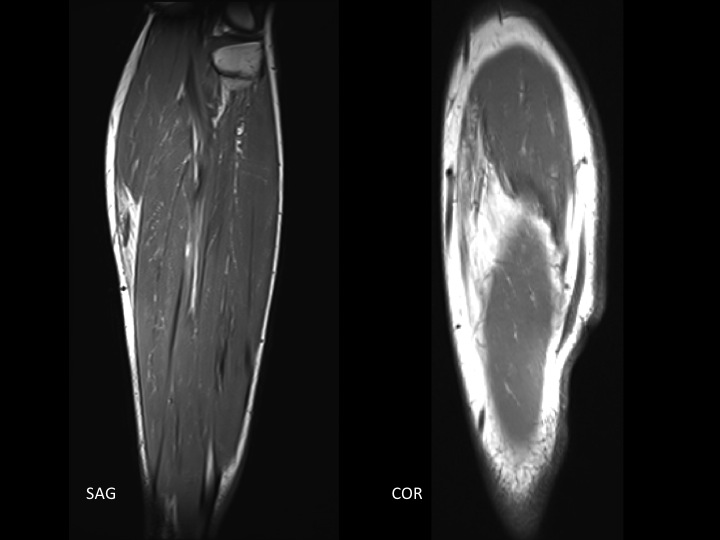 Figure 4 for case soleus muscle ( RID2924 )